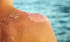 Bỏng nắng phải làm gì để tránh tổn thương da nghiêm trọng?