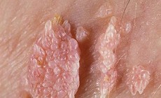 Dấu hiệu nhận biết sớm bệnh sùi mào gà ở phụ nữ