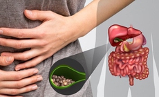 Bệnh sỏi túi mật phổ biến nhưng thường bị xem nhẹ, cảnh báo biến chứng nặng