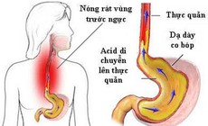 5 nguy cơ khi dùng nhiều thuốc giảm tiết acid ở người trào ngược dạ dày - thực quản