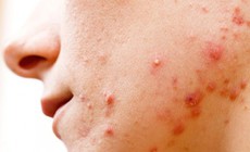Mụn trứng cá bọc có nên nặn không?