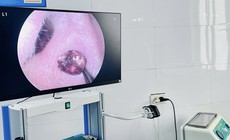 Đau nhức tai suốt một tuần, người phụ nữ tá hỏa vì 'vị khách lạ' trong tai