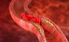 Thay đổi lối sống giúp kiểm soát cholesterol cao, giảm nguy cơ bệnh tim mạch