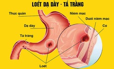 Những nguy cơ khi tự ý dùng meloxicam trị đau xương khớp