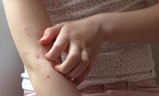 Dấu hiệu ngứa do ký sinh trùng