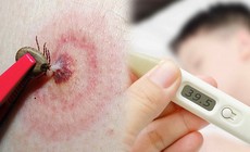 Suy đa tạng do mò đốt, đặc trưng của bệnh sốt mò cần biết