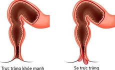 Sa trực tràng ở trẻ em có nguy hiểm?