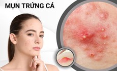 Mụn trứng cá kéo dài tới tuổi nào mới hết?