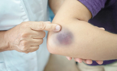 Xuất hiện nhiều vết bầm tím không rõ nguyên nhân cảnh giác với giảm tiểu cầu