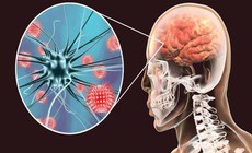 Viêm não tự miễn có nguy cơ tử vong cao nếu chẩn đoán muộn