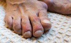 Hạt tophi ở người bệnh gout khi nào cần xử trí?