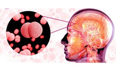 Nhận biết sớm dấu hiệu viêm não nguy hiểm
