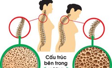 Tuổi nào bắt đầu bị loãng xương và cách phòng bệnh hiệu quả từ sớm