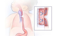 Teo thực quản bẩm sinh cần phát hiện sớm