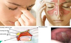 Viêm mũi xoang mùa mưa: Đừng chủ quan với những cơn nghẹt mũi kéo dài