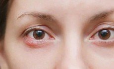 Ngứa rát, khô mắt kéo dài, cảnh giác với viêm bờ mi