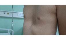 4 dấu hiệu phát hiện lõm ngực bẩm sinh ở trẻ