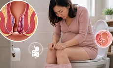 Mẹ bầu làm gì để giảm nguy cơ mắc bệnh trĩ?