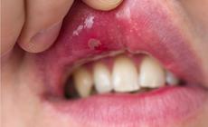 5 lưu ý chăm sóc răng miệng cho người bệnh Lupus ban đỏ