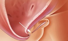 Lỗ tiểu thấp ở bé trai, có nên cắt bao quy đầu sớm?