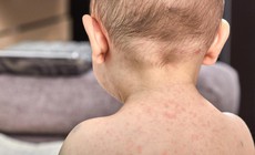 Mỹ đối mặt nguy cơ bùng phát dịch sởi tồi tệ nhất sau 35 năm