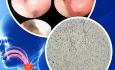 Phẫu thuật thành công dị tật đường thở hiếm gặp cho bé gái 1 tháng tuổi