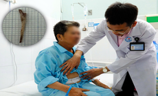 Người đàn ông suýt mất mạng vì mảnh xương đâm thủng dạ dày