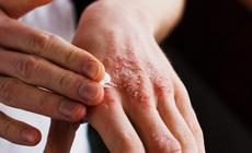 Cần làm gì khi nghi ngờ bị viêm da tiếp xúc?