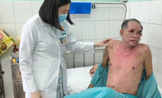 Dị ứng thuốc nhỏ mắt, người đàn ông bị hoại tử thượng bì nhiễm độc nguy kịch