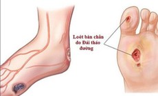 Tê rần bàn chân ở người tiểu đường cần chú ý biến chứng thần kinh