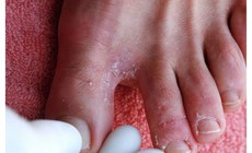 Bệnh ngoài da hay gặp mùa mưa bão