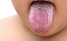 Những yếu tố làm tăng nguy cơ mắc lưỡi bản đồ