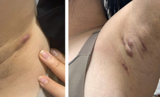 Viêm tuyến mồ hôi mủ dễ nhầm với mụn nhọt, áp xe