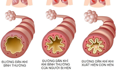 Phòng tránh cơn hen cấp lúc giao mùa