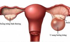 U nang buồng trứng ác tính có chữa được không?