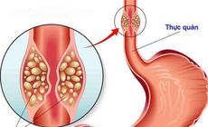 Triệu chứng hẹp thực quản: Đừng chủ quan khi thường xuyên nuốt nghẹn