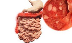 Viêm ruột có nguy hiểm không?
