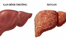 Chưa bị xơ gan vẫn có thể mắc ung thư gan