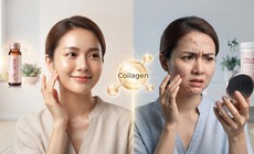 Bổ sung collagen có bị nổi mụn?