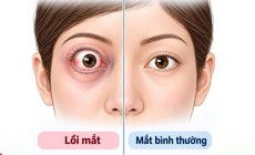 Mắt lồi, mất thị lực do khối u nằm sâu sau nhãn cầu