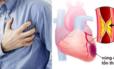 Nhồi máu cơ tim cấp do tắc mạch vành ở người hút thuốc lá nhiều năm