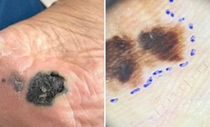 Mảng đen dưới lòng bàn chân: Dấu hiệu ung thư da dễ bị bỏ qua