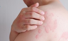 Nổi mề đay có nguy hiểm không?