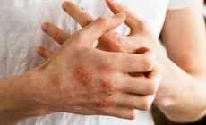 Ngứa kéo dài có thể là dấu hiệu của bệnh gì?