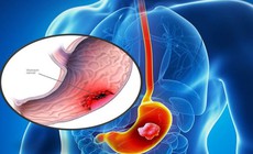 6 dấu hiệu cảnh báo ung thư dạ dày cần biết