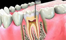 Viêm quanh răng gây hệ lụy gì?

