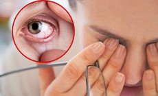 Chăm sóc người bị xuất huyết dưới kết mạc tại nhà