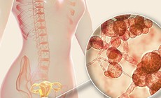 Mẹ bầu mắc nấm âm đạo nên uống thuốc hay đặt thuốc?