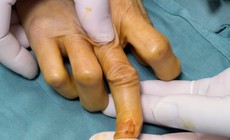 Phẫu thuật chuyển gân thành công cho bệnh nhân bị đứt gân duỗi ngón tay suốt 30 ngày