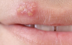 C&#225;ch ph&#242;ng tr&#225;nh l&#226;y nhiễm Herpes sinh dục